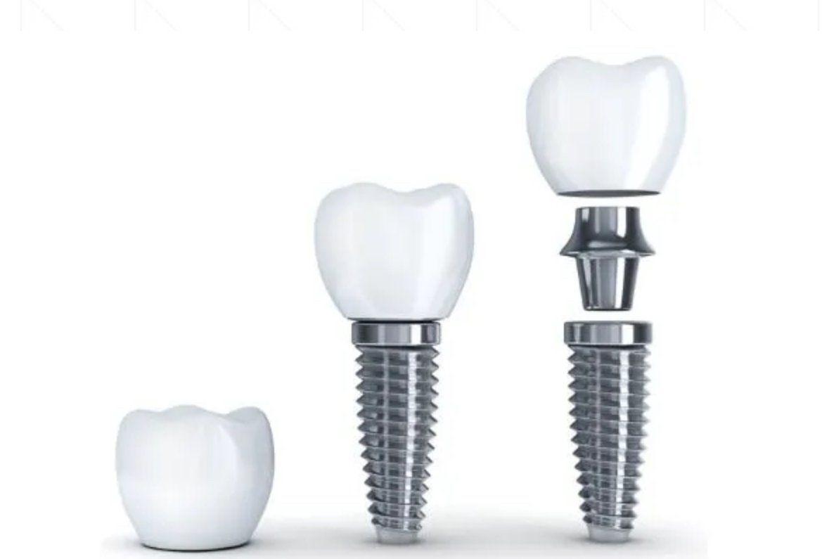 Implant